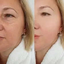 Profhilo y la nueva conversación sobre calidad de piel